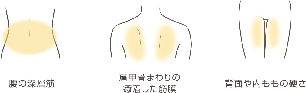 腰の深層筋、肩甲骨まわりの癒着した筋膜、背面や内ももの硬さのイラスト